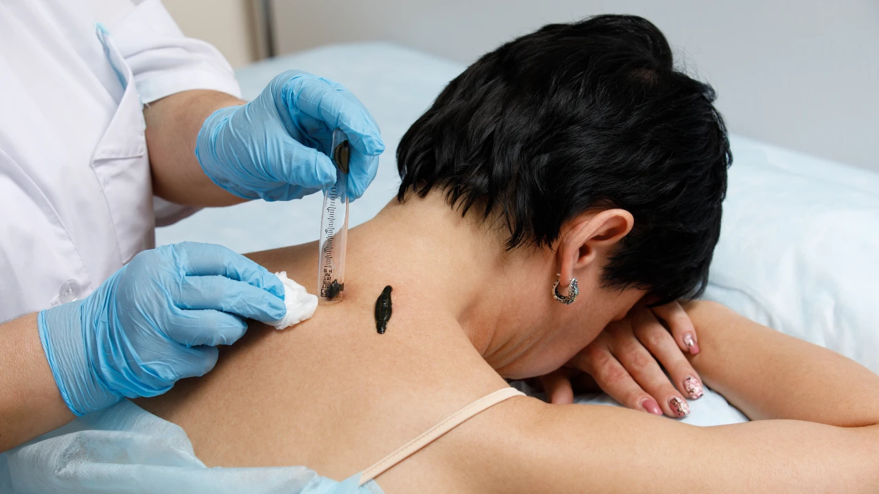 Гирудотерапия в санатории «Казахстан» 