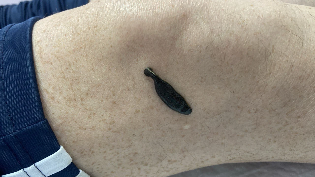 Гирудотерапия в санатории «Казахстан» 